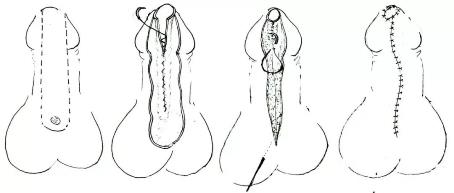 健康報 男性無法站著排尿？2.jpg